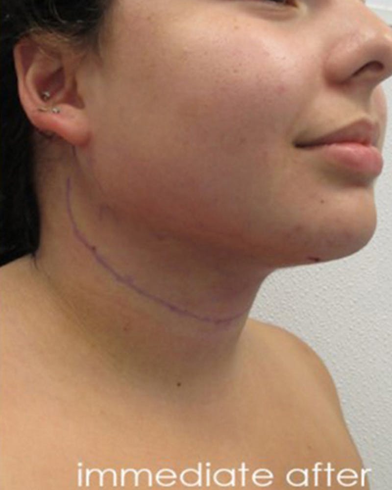 Neck Liposuction Before & After Gallery - Patient 109692 - Image 4