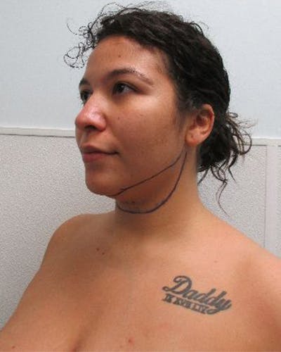 Neck Liposuction Before & After Gallery - Patient 402186 - Image 1
