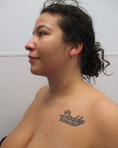 Neck Liposuction Before & After Gallery - Patient 402186 - Image 2