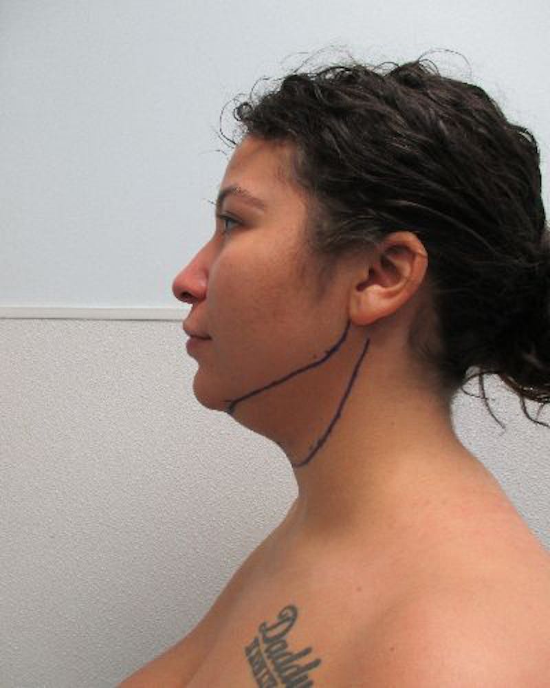 Neck Liposuction Before & After Gallery - Patient 402186 - Image 3