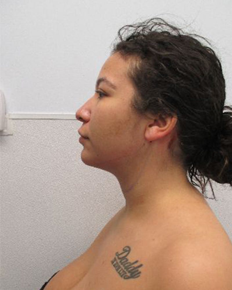 Neck Liposuction Before & After Gallery - Patient 402186 - Image 4