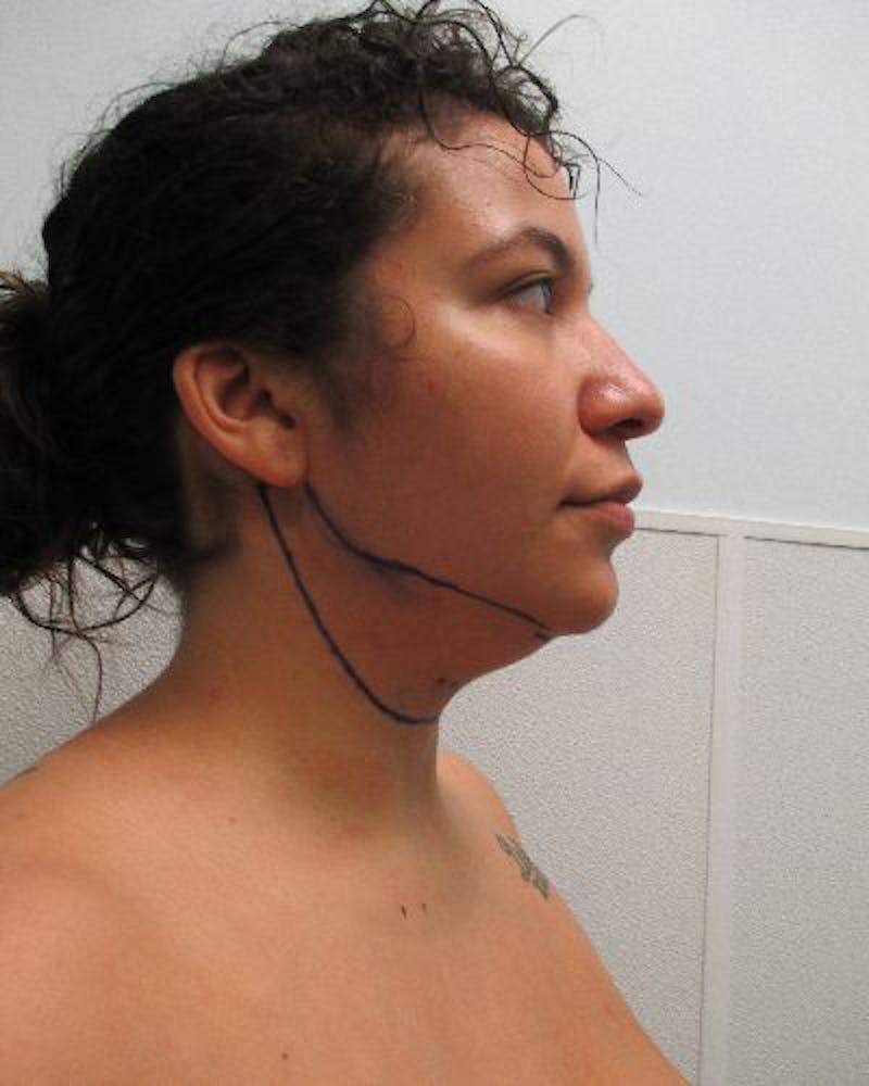 Neck Liposuction Before & After Gallery - Patient 402186 - Image 5