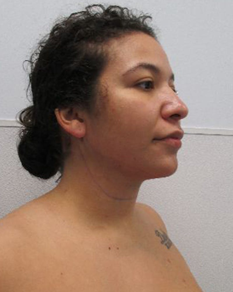 Neck Liposuction Before & After Gallery - Patient 402186 - Image 6