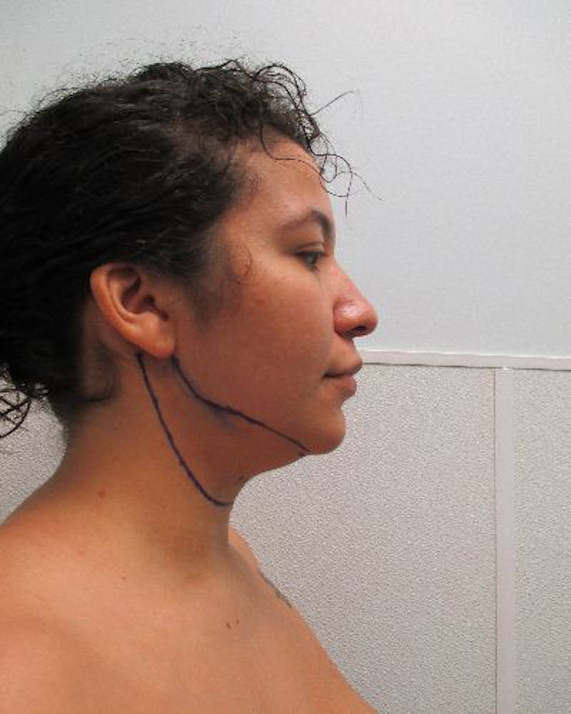 Neck Liposuction Before & After Gallery - Patient 402186 - Image 7