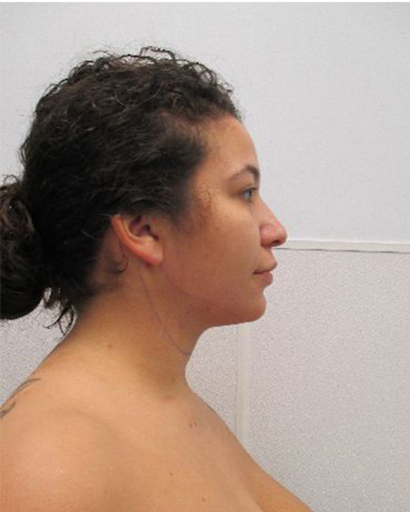 Neck Liposuction Before & After Gallery - Patient 402186 - Image 8