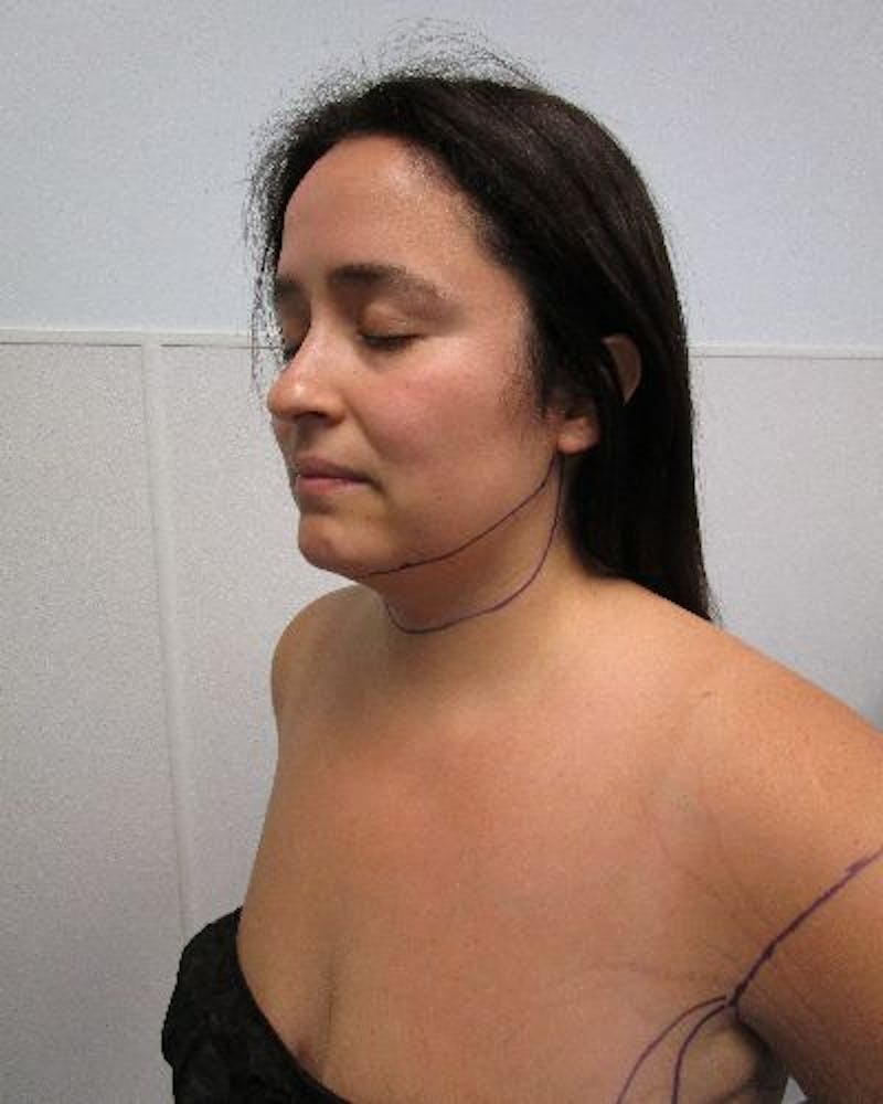 Neck Liposuction Before & After Gallery - Patient 334657 - Image 1