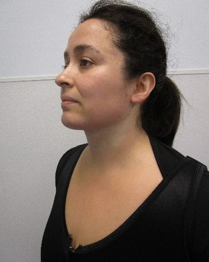 Neck Liposuction Before & After Gallery - Patient 334657 - Image 2