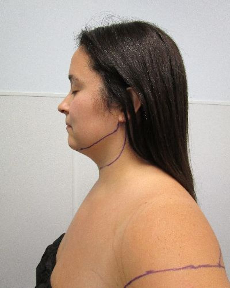 Neck Liposuction Before & After Gallery - Patient 334657 - Image 3
