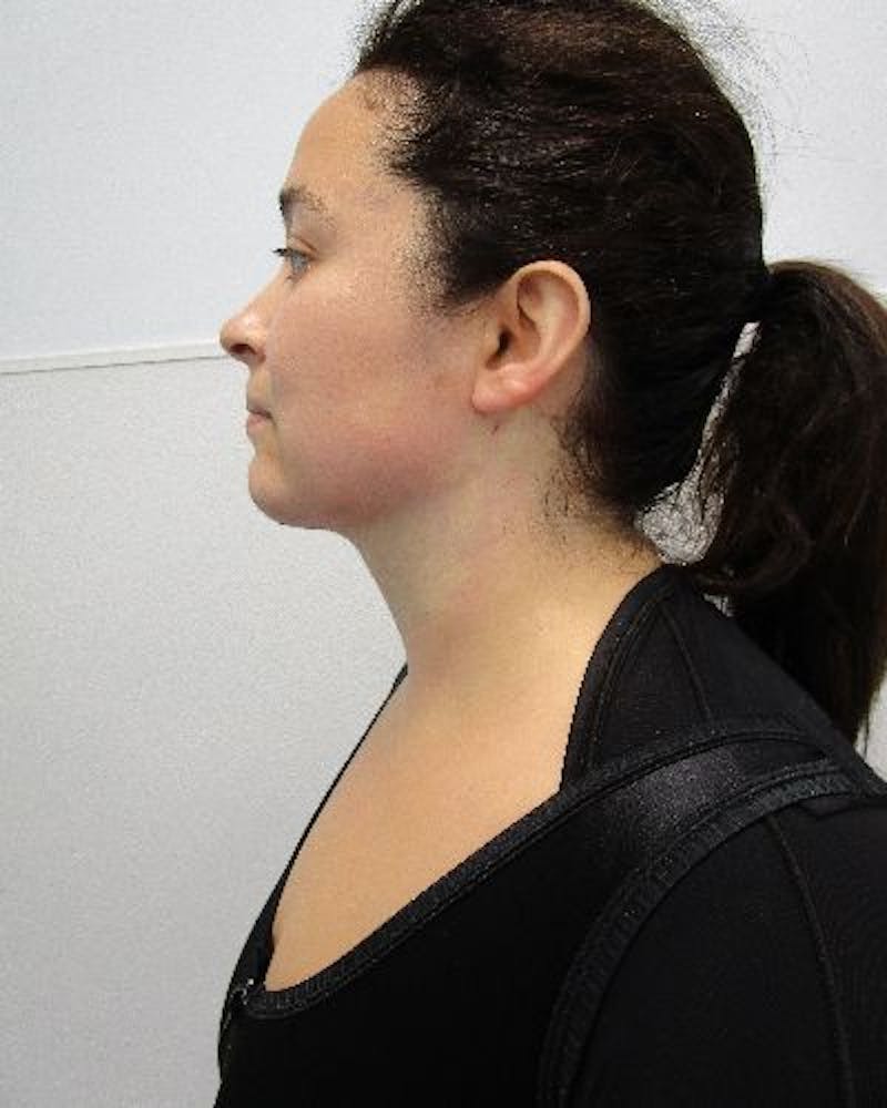 Neck Liposuction Before & After Gallery - Patient 334657 - Image 4