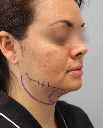 Neck Liposuction Before & After Gallery - Patient 170941 - Image 1