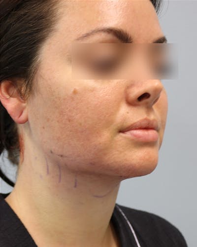Neck Liposuction Before & After Gallery - Patient 170941 - Image 2