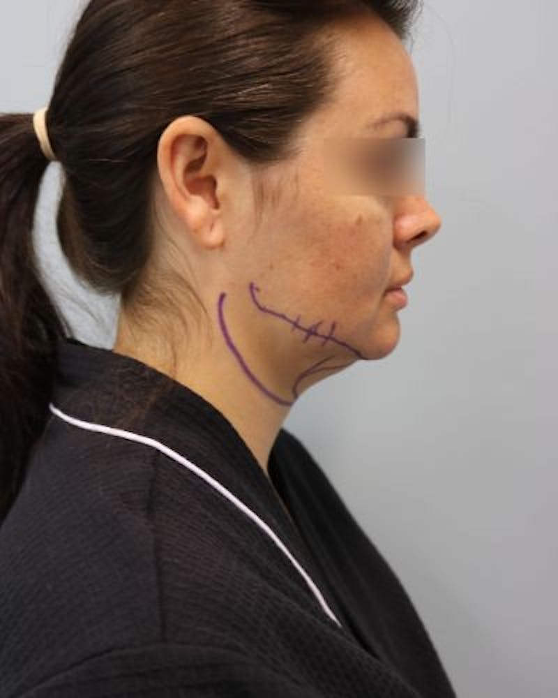 Neck Liposuction Before & After Gallery - Patient 170941 - Image 3