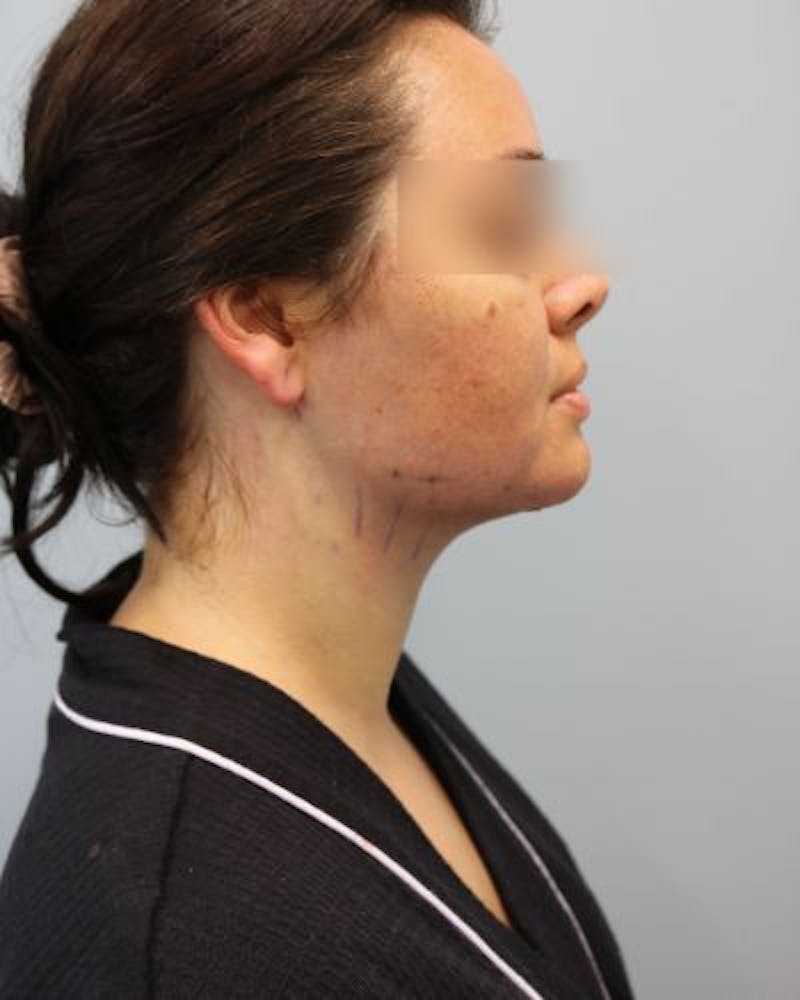 Neck Liposuction Before & After Gallery - Patient 170941 - Image 4