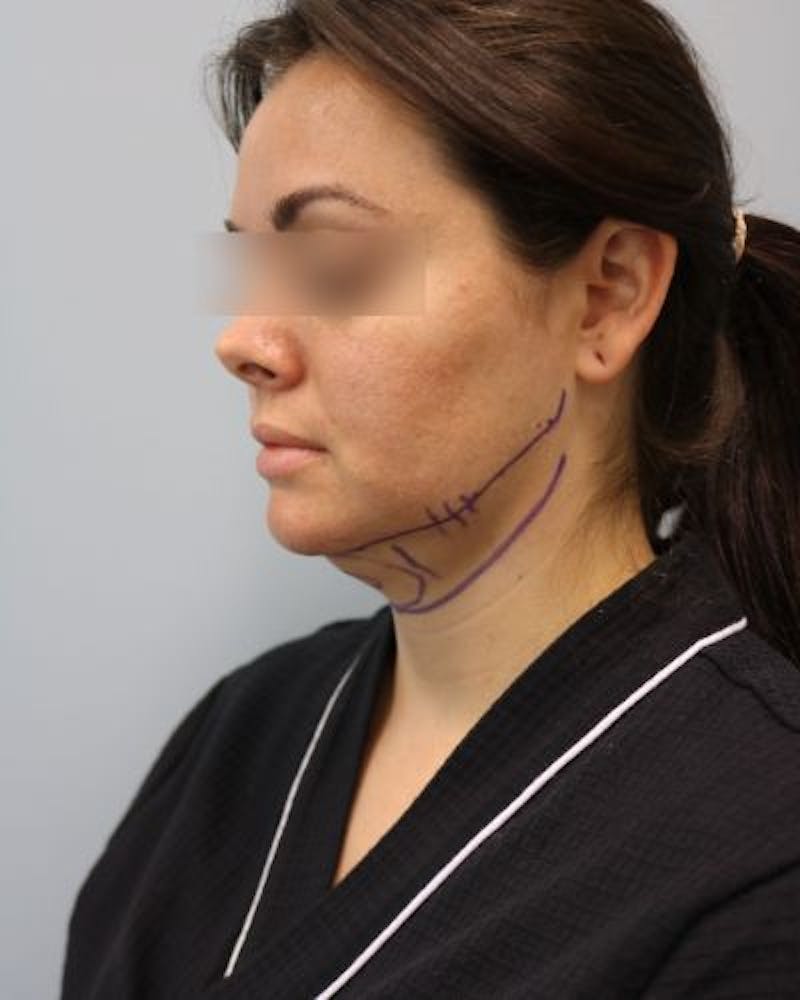 Neck Liposuction Before & After Gallery - Patient 170941 - Image 5