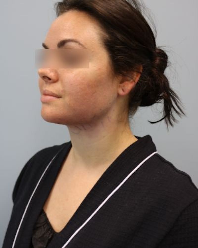 Neck Liposuction Before & After Gallery - Patient 170941 - Image 6