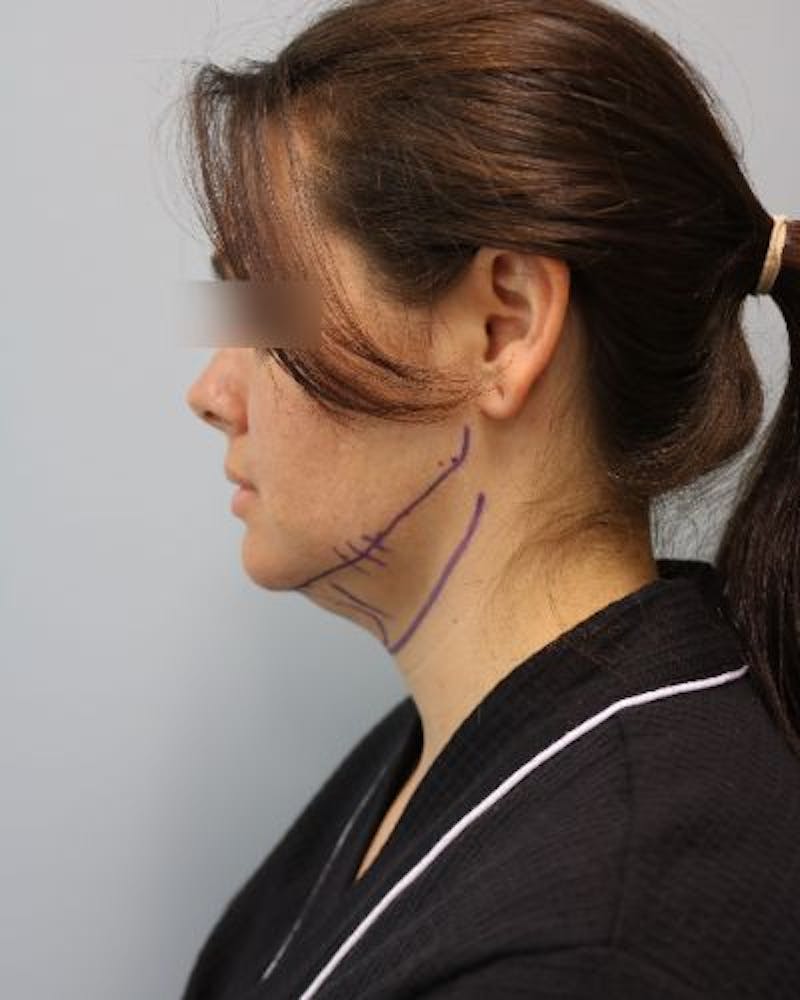 Neck Liposuction Before & After Gallery - Patient 170941 - Image 7