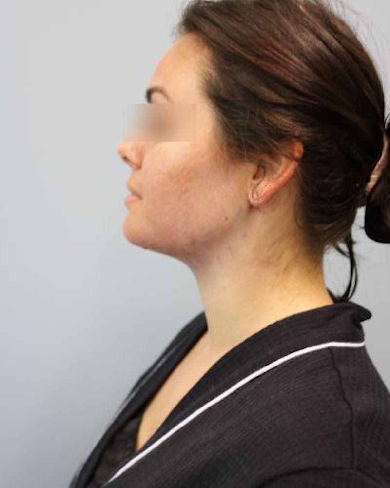 Neck Liposuction Before & After Gallery - Patient 170941 - Image 8