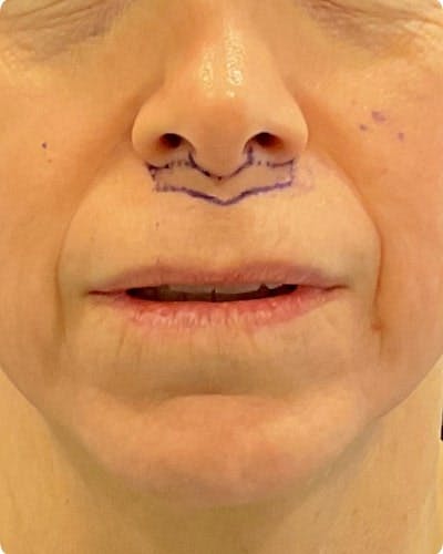 Lip Lift Before & After Gallery - Patient 155955 - Image 1