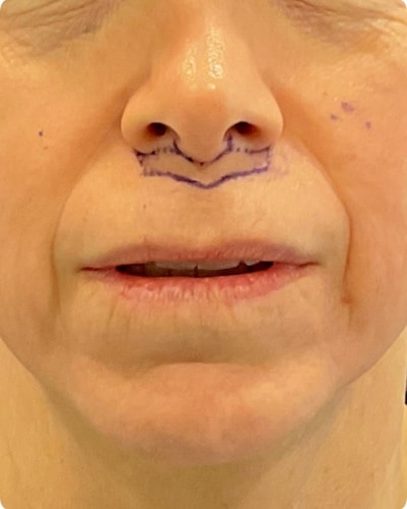 Lip Lift Before & After Gallery - Patient 155955 - Image 1