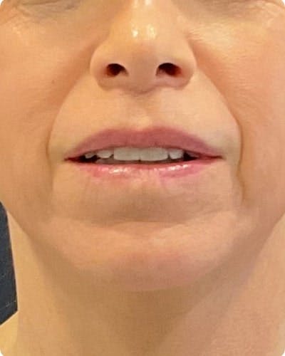 Lip Lift Before & After Gallery - Patient 155955 - Image 2