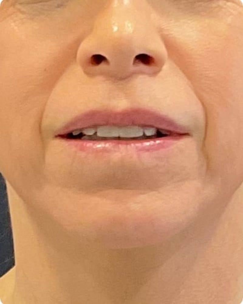 Lip Lift Before & After Gallery - Patient 155955 - Image 2