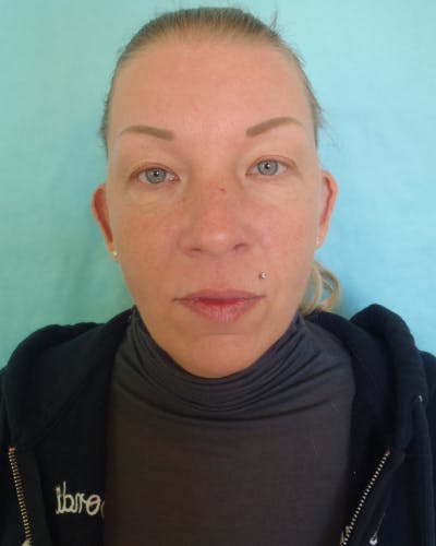 Otoplasty Before & After Gallery - Patient 280095 - Image 1