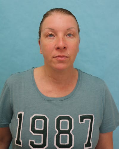 Otoplasty Before & After Gallery - Patient 280095 - Image 2