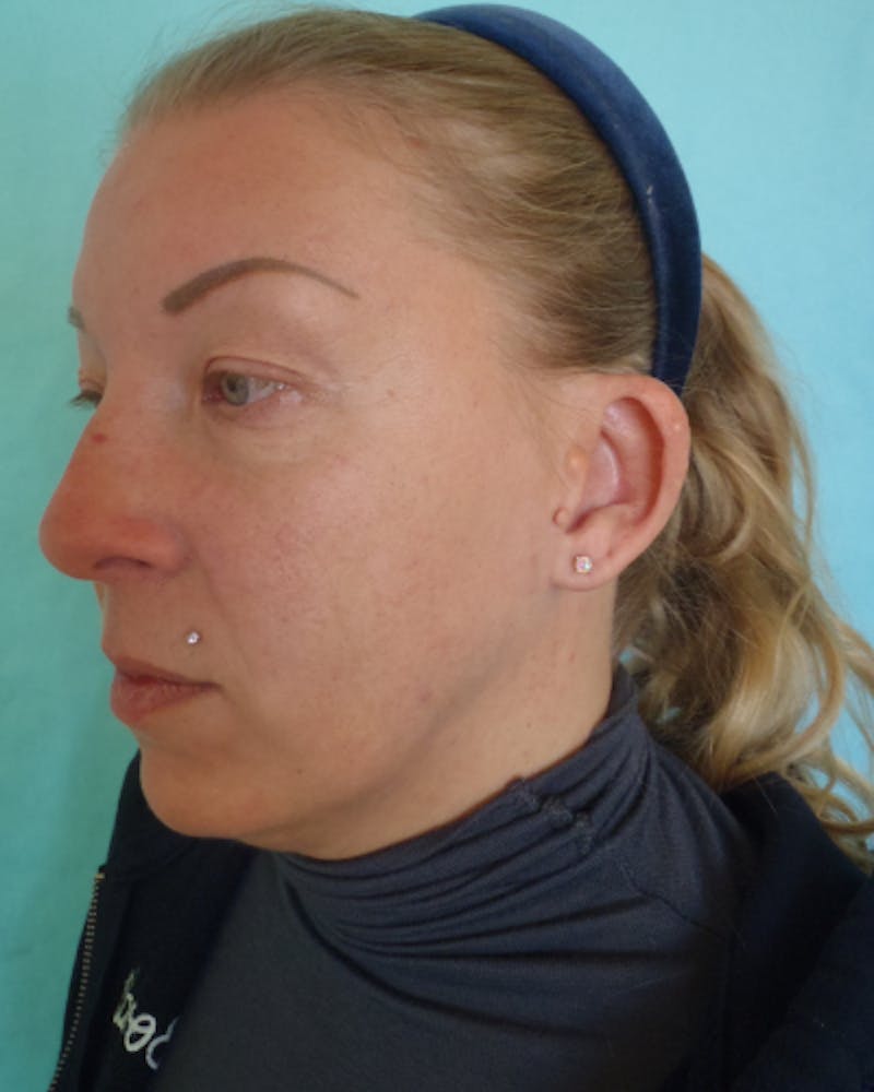 Otoplasty Before & After Gallery - Patient 280095 - Image 3