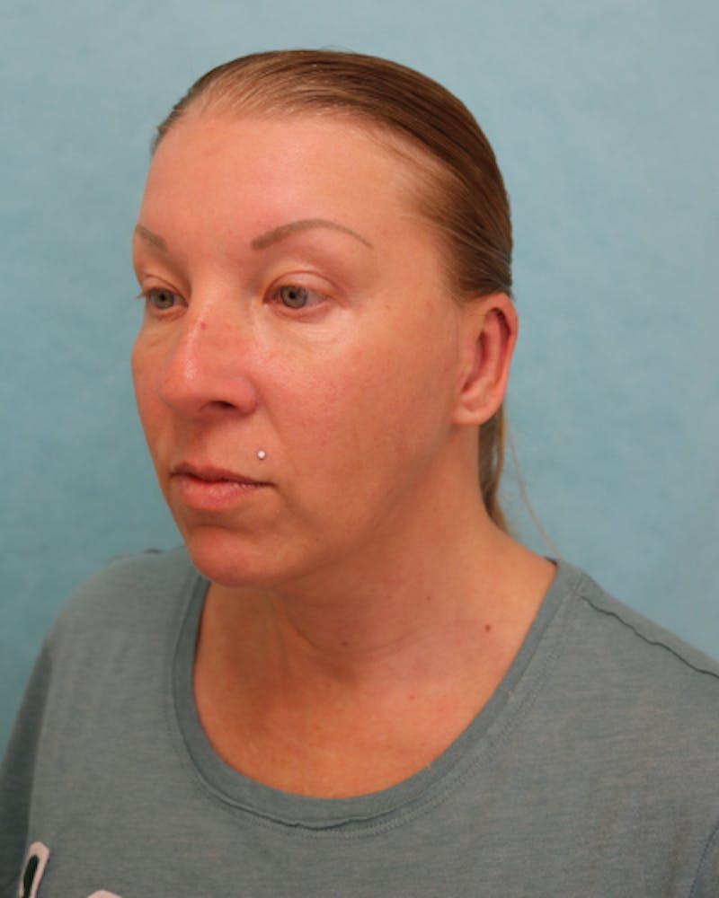 Otoplasty Before & After Gallery - Patient 280095 - Image 4