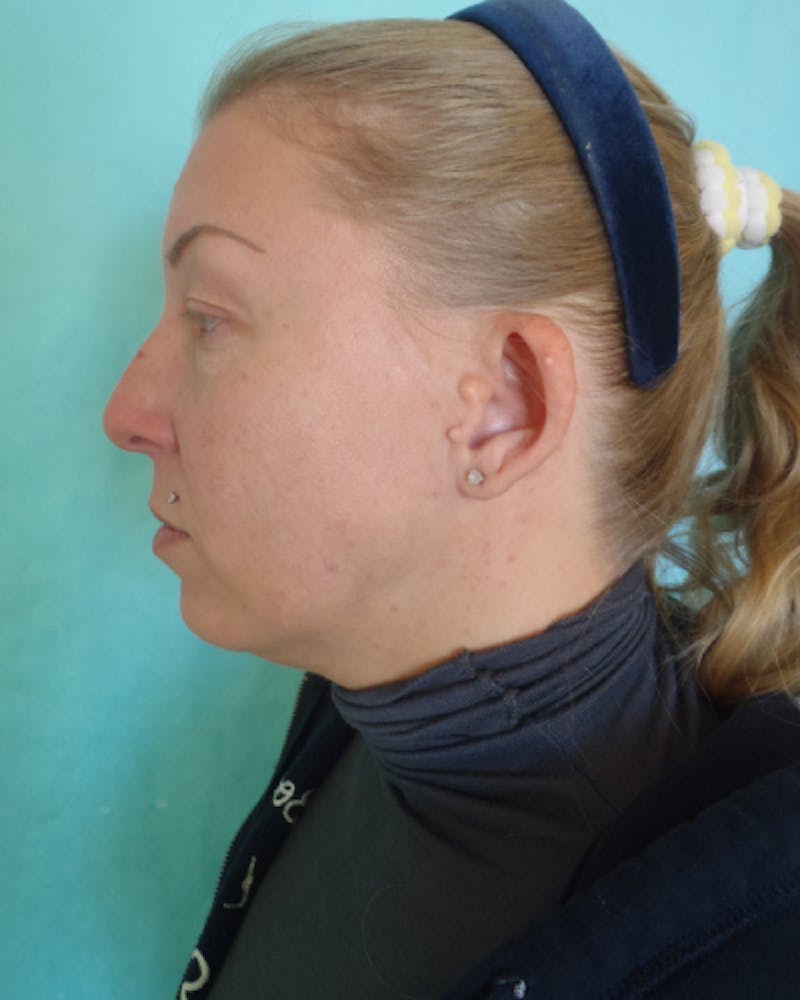 Otoplasty Before & After Gallery - Patient 280095 - Image 5