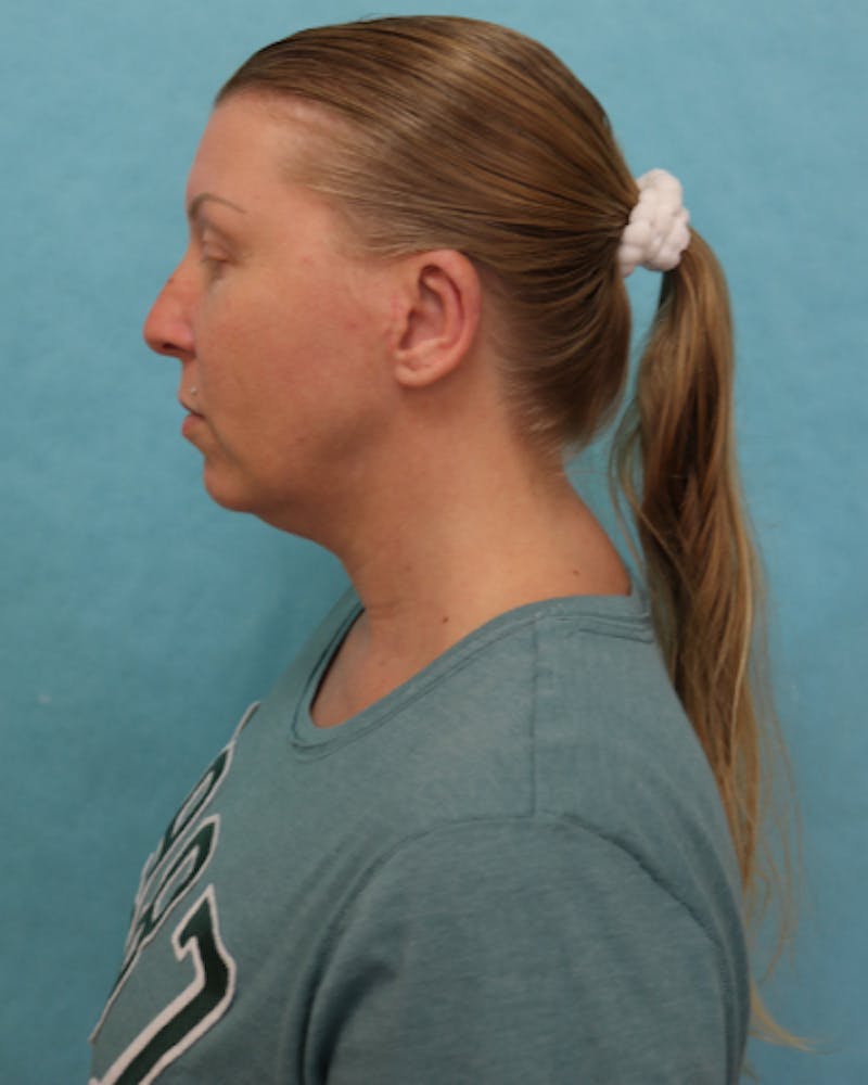 Otoplasty Before & After Gallery - Patient 280095 - Image 6
