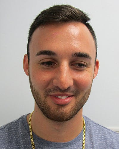 Rhinoplasty Before & After Gallery - Patient 118119 - Image 1