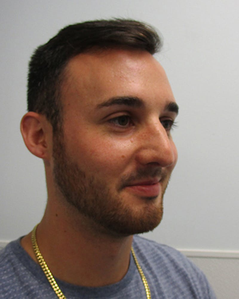 Rhinoplasty Before & After Gallery - Patient 118119 - Image 3