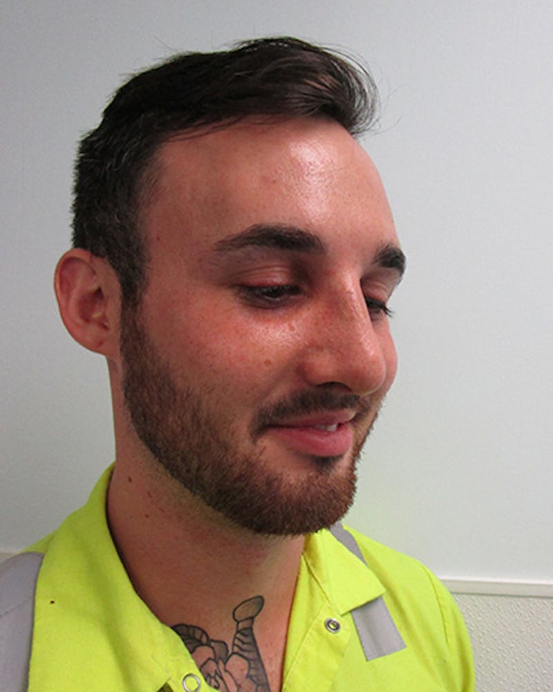 Rhinoplasty Before & After Gallery - Patient 118119 - Image 4