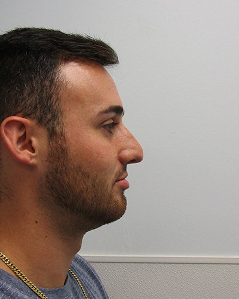 Rhinoplasty Before & After Gallery - Patient 118119 - Image 5