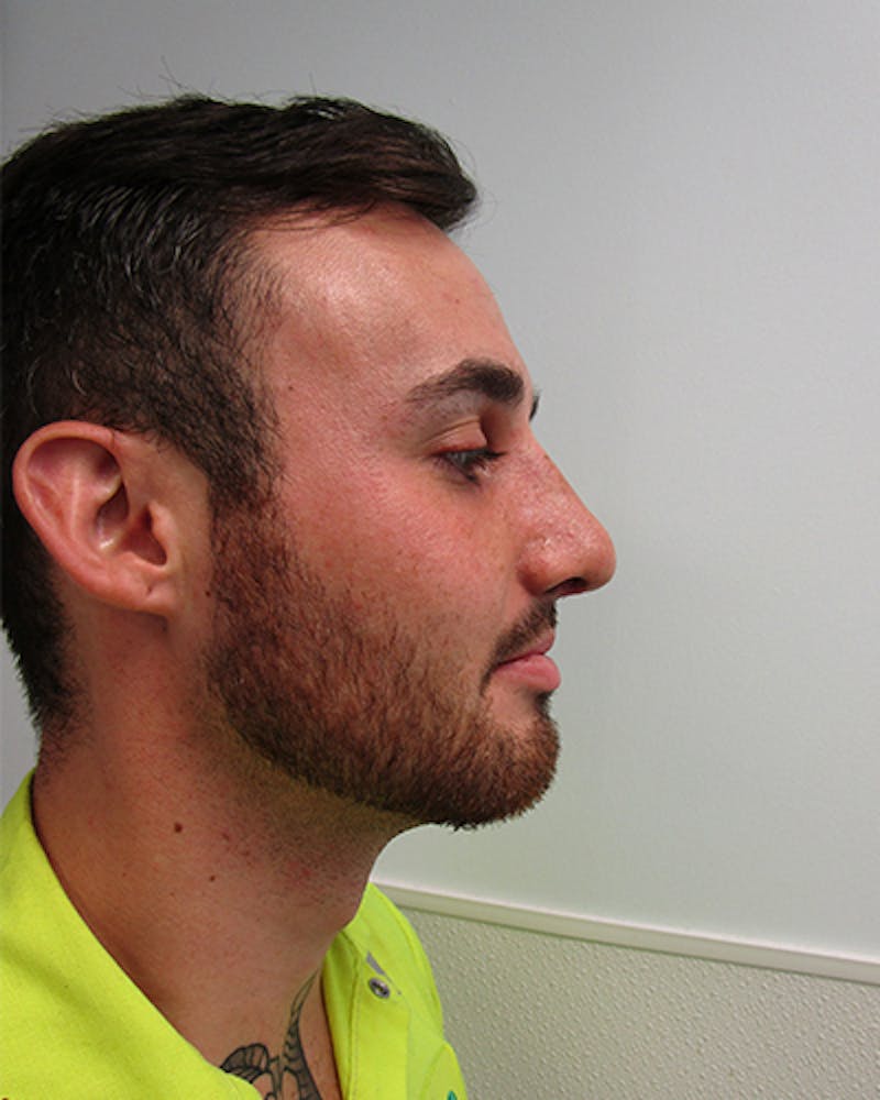 Rhinoplasty Before & After Gallery - Patient 118119 - Image 6
