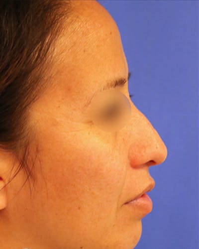 Rhinoplasty Before & After Gallery - Patient 154865 - Image 1