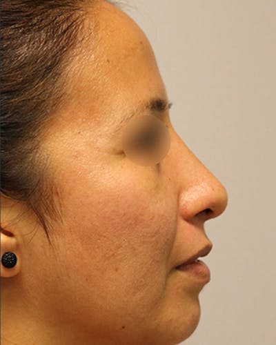 Rhinoplasty Before & After Gallery - Patient 154865 - Image 2