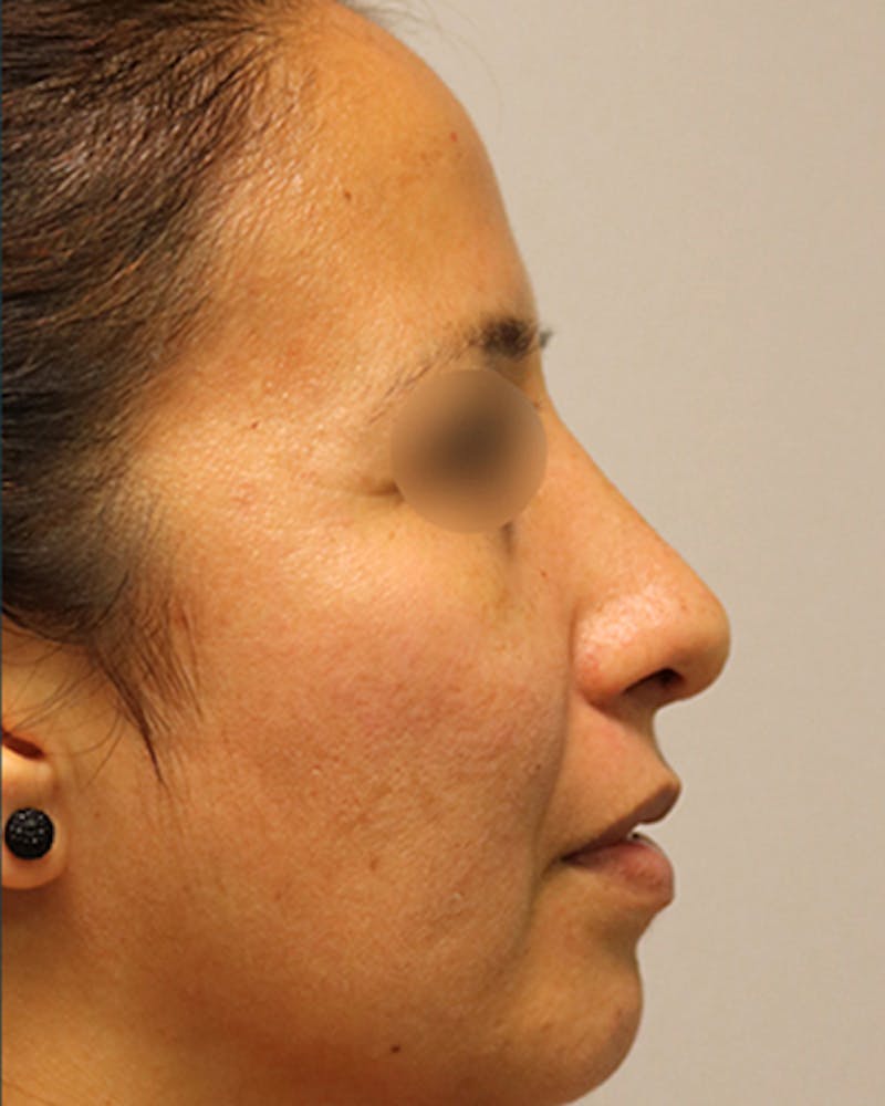 Rhinoplasty Before & After Gallery - Patient 154865 - Image 2
