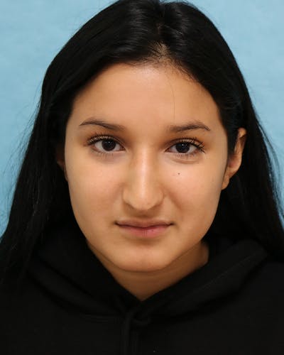 Rhinoplasty Before & After Gallery - Patient 250902 - Image 1