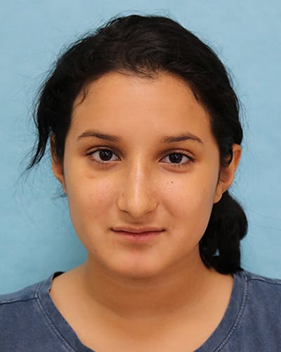 Rhinoplasty Before & After Gallery - Patient 250902 - Image 2