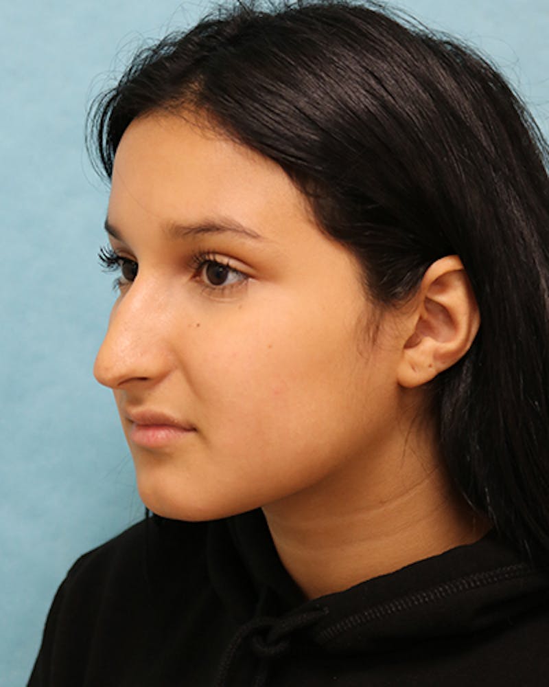 Rhinoplasty Before & After Gallery - Patient 250902 - Image 3