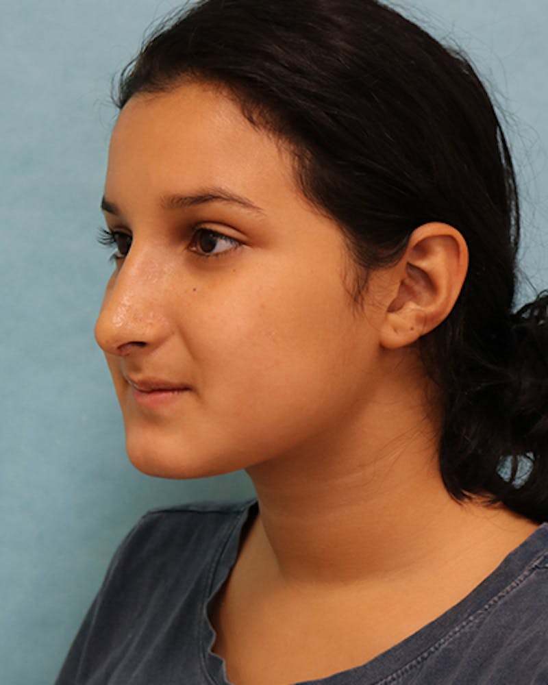 Rhinoplasty Before & After Gallery - Patient 250902 - Image 4