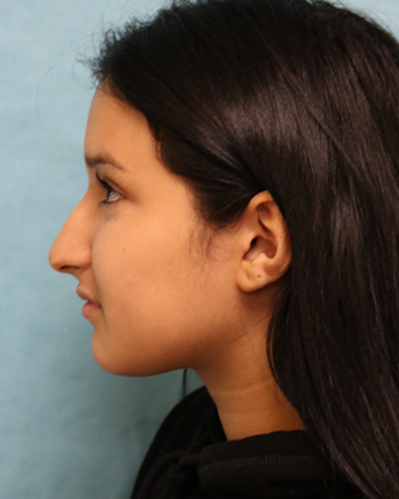 Rhinoplasty Before & After Gallery - Patient 250902 - Image 5