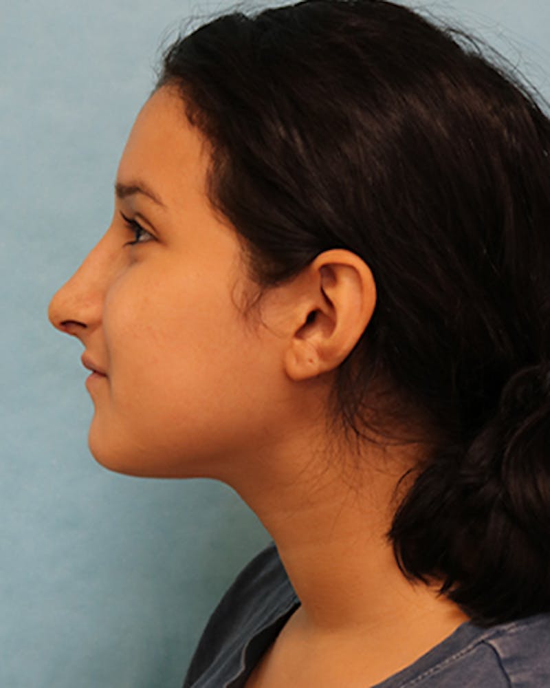 Rhinoplasty Before & After Gallery - Patient 250902 - Image 6