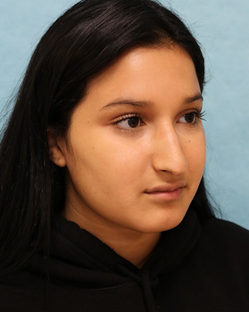 Rhinoplasty Before & After Gallery - Patient 250902 - Image 7