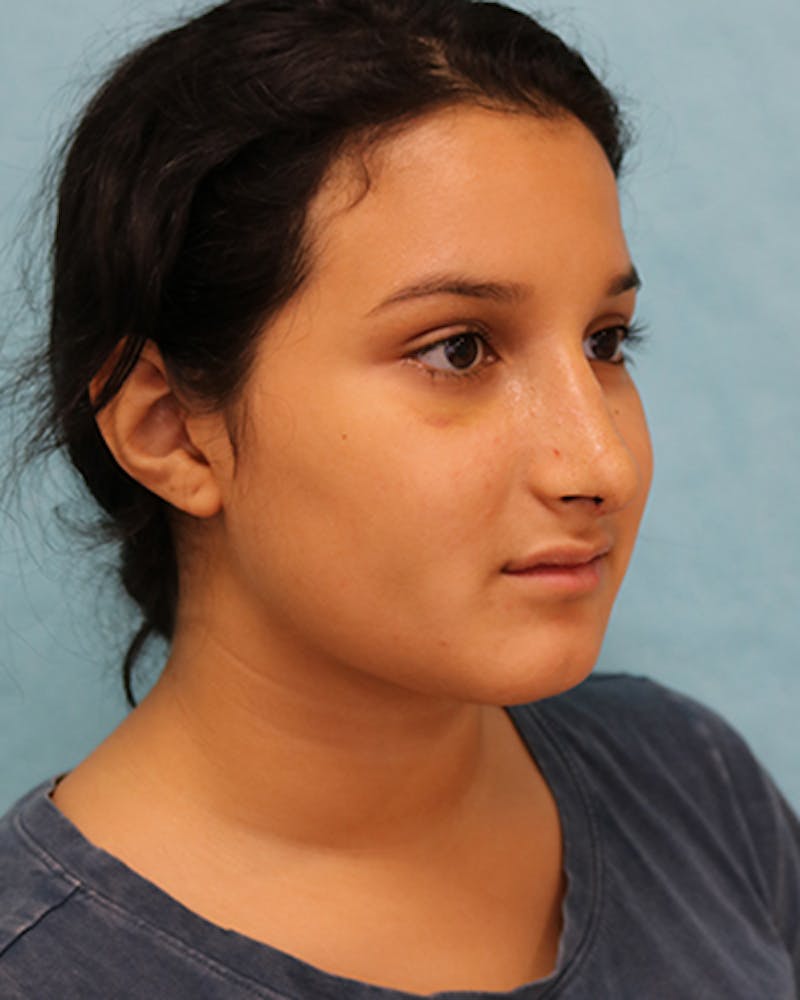 Rhinoplasty Before & After Gallery - Patient 250902 - Image 8