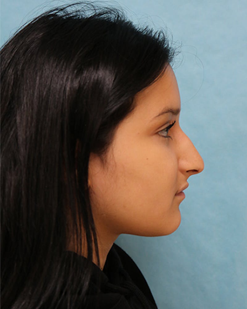 Rhinoplasty Before & After Gallery - Patient 250902 - Image 9