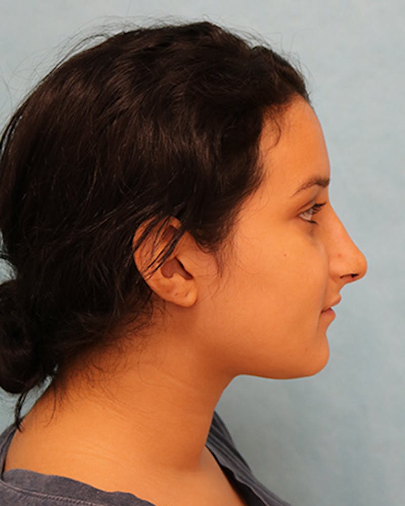 Rhinoplasty Before & After Gallery - Patient 250902 - Image 10