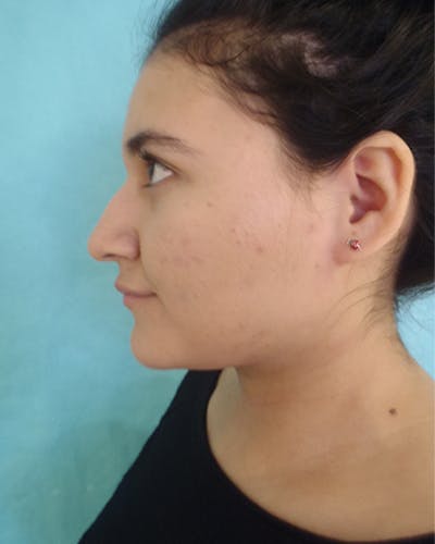Rhinoplasty Before & After Gallery - Patient 342076 - Image 1